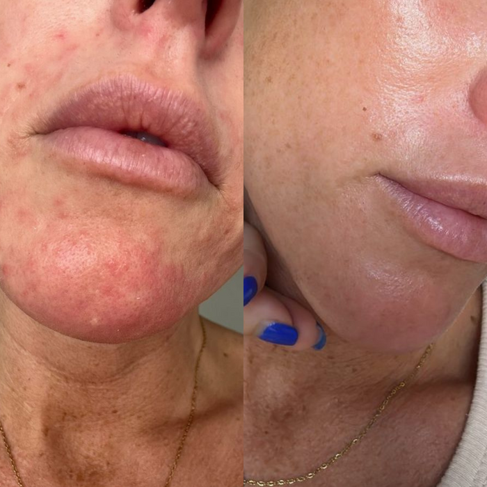 Sea Cucumber Collagen Sensitive Skin Pack