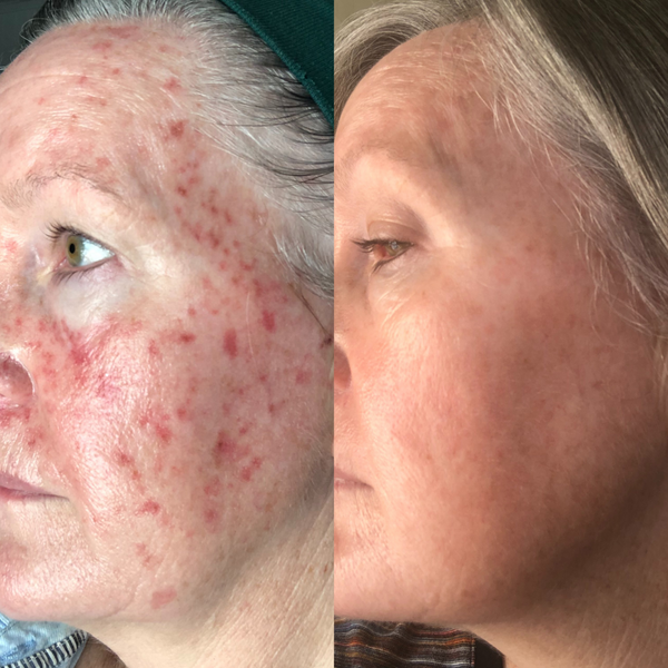 Sea Cucumber Collagen Firming and Renewal Pack